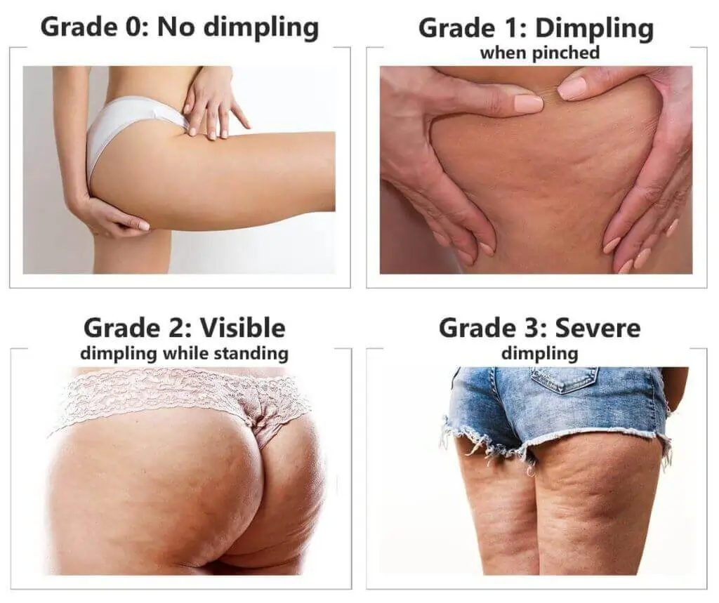 Representation of the stages of cellulite development East Grinstead